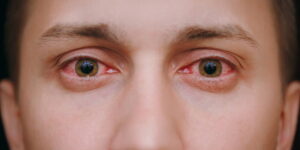 persona con ojos rojos a causa del síndrome de Sjogren
