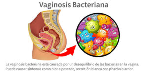 infografía sobre la vaginosis bacteriana